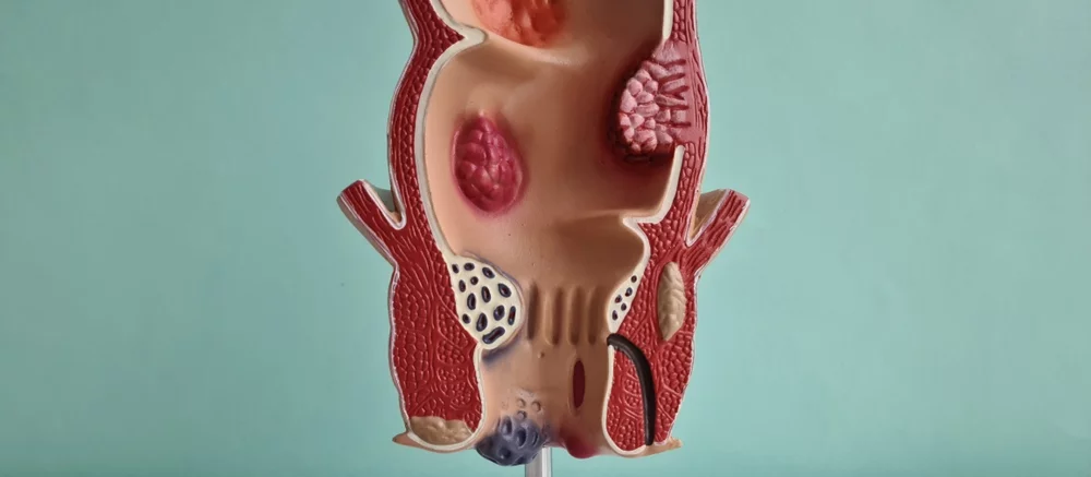 Model konečníka – anatomický prierez s vyznačenými typickými problémami v oblasti konečníka.