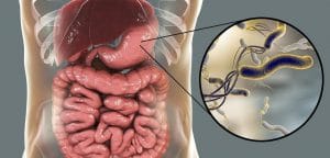 Infekcia Helicobacter pylori