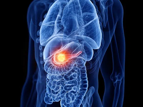 Rakovina pankreasu, príčiny vzniku, liečba